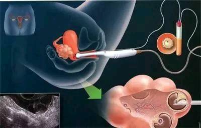 在这4个问题中了解供卵试管婴儿PGD-PGS的所有风险和准确性