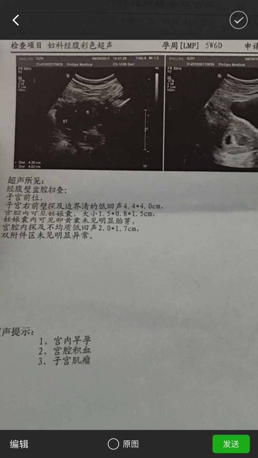 赠卵借卵试管供卵和正常婴儿一样吗--读完你就明白了