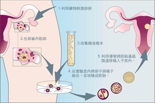 泰国做供卵借卵试管婴儿能决定男女吗一看就知道