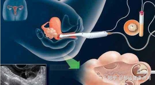 供卵试管代生费用的具体流程