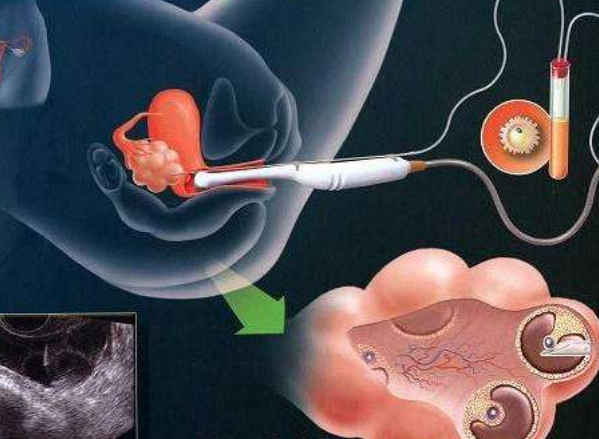 供卵试管婴儿与自然怀孕的娃娃有区别吗