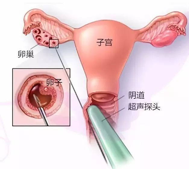 湖北第三代借卵做试管婴儿价格