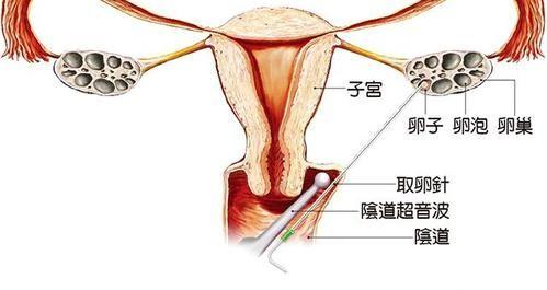 湖北中信湘雅借卵试管婴儿医院咨询电话