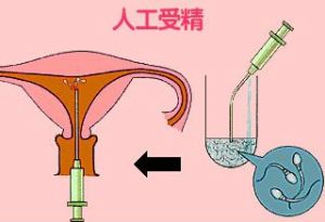 多囊卵巢也有“胖瘦”之分？多囊日常应该怎么减肥？